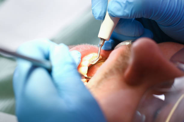 Best Emergency Tooth Extraction in Quail Creek, TX